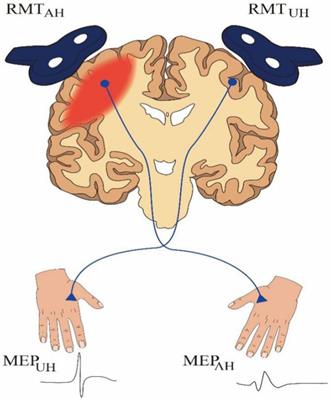 The assessment of interhemispheric imbalance using functional near-infrared spectroscopic and transcranial magnetic stimulation for predicting motor outcome after stroke
